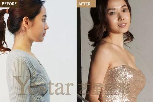 明星隆胸 痕迹,揭秘明星美丽背后的秘密